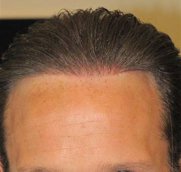 Exoderm artificial Hair Implant