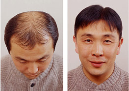 Hair implant Exoderm