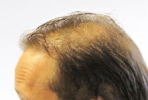 Hair implant Exoderm