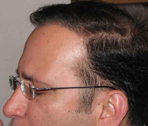 Exoderm Biofibre Hair transplant